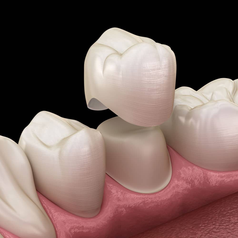 dental bridges