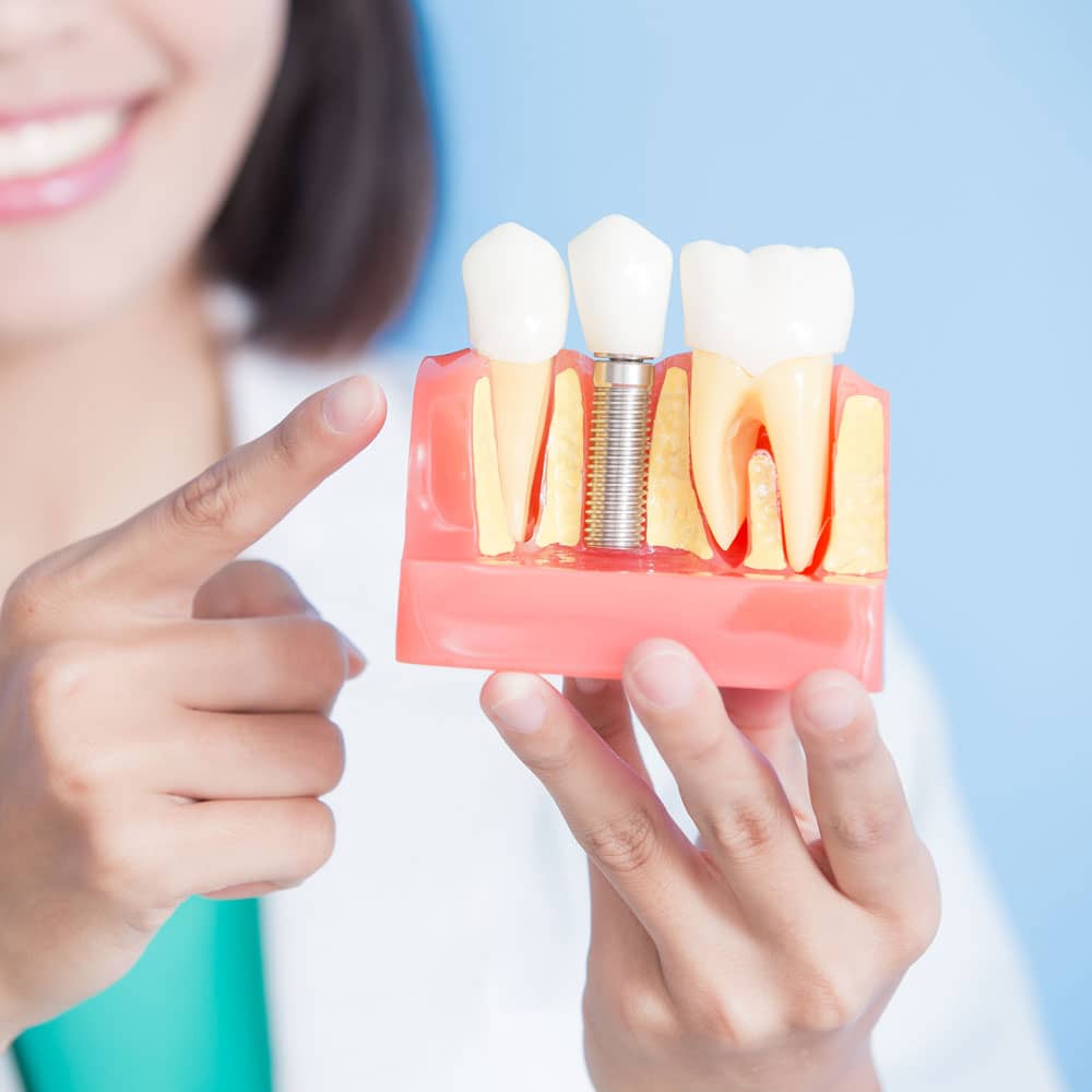 dental implants