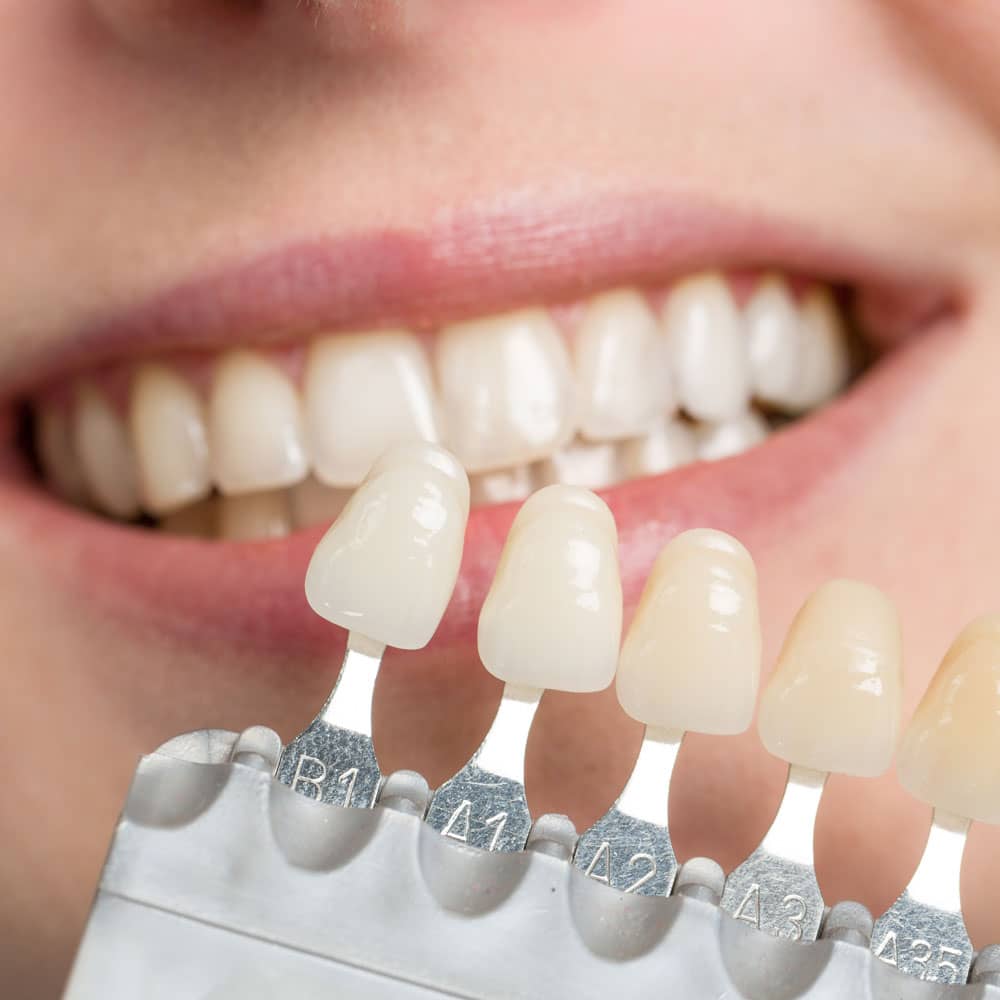 dental venneers